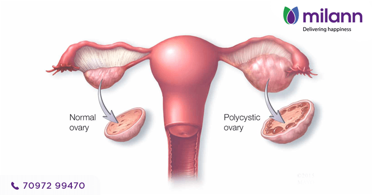 Comparison of Normal ovary and Polycystic Ovary which can be treated at Milann Fertility Center.